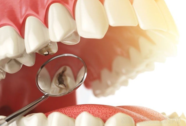 Hạt bo bo hỗ trợ điều trị sâu răng.
